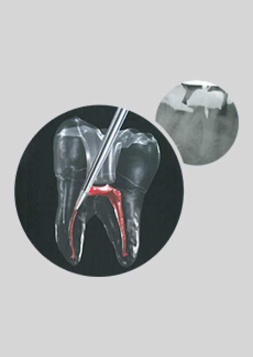 FRESE SS WHITE ENDOGUIDE Frese e abrasivi Prodotti odontoiatrici DENTAL PROVIDES a Andria