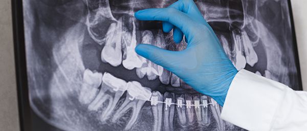Radiografia Prodotti odontoiatrici DENTAL PROVIDES a Andria